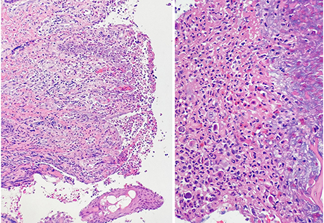 Figure 4 Low power images (right) showing surface ulceration and superficial dermal infiltrate, and (left) high power image showing epidermal necrosis with predominantly dermal eosinophilic inflammatory infiltrate.
