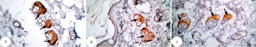 Figure 16 Photomicrographs of immunohistochemically stained breast tissue sections showing the effect of DMBA on antiapoptotic marker bcl-2 expression (indicated by the arrows) (A, B, and C; ×400).