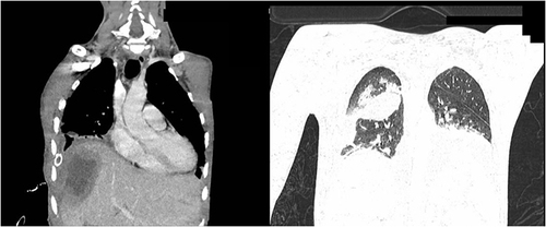 Figure 3 Computed tomography of the chest with a reduction in the amount of purulent content and partial visualization of the right lung.