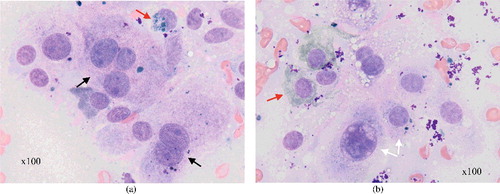 Figure 2. Cytology from case 1: (a) multinucleate cells (black arrows) with variable pigmentation (red arrow); (b) a high degree of cellular pigment (red arrow) and the marked pleomorphism (white arrows).