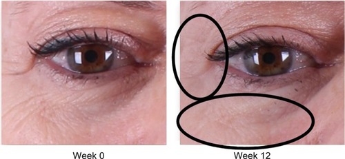 Figure 3 Improvement of crow’s feet and decrease in fine rhytides in the identified regions.