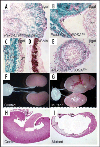Figure 2 Inactivation of Cnb1 in the metanephric and ureteric mesenchyme causes congenital obstructive nephropathy. (A–E) are samples from P1 Pax3-CreT/+, ROSAT/+ mice. In the kidney proper, LacZ expression (blue, reflecting the Cre expression) is evident in the glomeruli and tubules that are MM-derived but not in the collecting duct system originated from the UB (A). The black arrow in (B) points to the developing glomeruli. The open arrow points to one of the UB branches. In the developing renal pelvic region, the connective tissues, the smooth muscle layers (SM) and the adventitia (AD) of the urinary tract express LacZ while the UB-derived urothelium (UT) remains LacZ-negative (C–E). U: ureter; PP: Papilla. The SM layers in the developing renal pelvic wall are illustrated by αSMA staining on a wild-type newborn sample of the same area (D). LacZ is also selectively expressed in the SM layers in the ureter but not in the stratified transitional epithelium (E). Mutants (Pax3-CreT/+, Cnb1lox/lox) have severe hydronephrosis and erosion of the kidney parenchyma (G and I compared with F and H. Samples G and H were collected at P12). Modified from Figures 2 and 3 from ref. Citation26 with permission.
