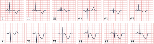 Figure 1 Example of an ECG feature in stroke, characterized by sinus rhythm, normal cardiac axis, giant inverted T waves.