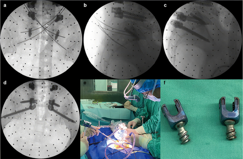 Figure 2 Intraoperative position of K-wires and screws in intraoperative fluoroscopy (a–d). An intraoperative pilot hole of the S1 CBT screw was prepared (e). Fractured S1 pedicle screw tails were removed (f).