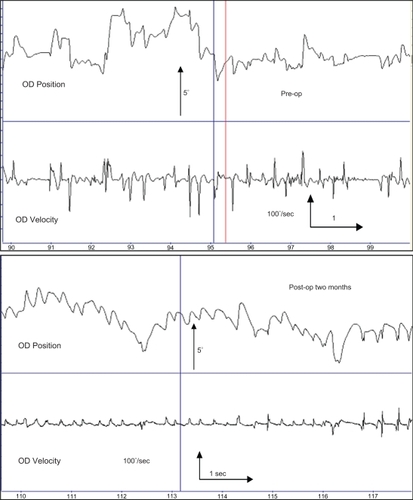 Figure 4 Eye movement recording of patient 16.