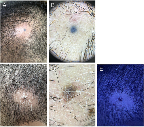 Figure 1 Case 1: (A) Macroscopic image showing an area of nonscarring alopecia, approximately 2.0×2.0 cm, without signs of inflammation, surrounding a 4-mm diameter well-circumscribed nevus, was observed in the left temporal region. (B) Dermoscopic image showed a well-circumscribed lesion with homogenous blue-grayish globular pattern, broken hairs, black dots, yellow dots and short vellus hairs. Case 2: (C) Macroscopic image revealed a patchy hair loss with a central nevus and surrounding hypopigmentation in the left temporal region. (D) With dermoscopy, we noticed a globular, dark brown pigmented tumor with peripheral areas of light-brown pigment, short vellus hairs and broken hairs. (E) Wood’s light examination of the area of alopecia was positive with fluorescence enhancement.