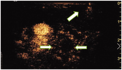 Figure 6. On the second day after ablation, CEUS showed that the ablated lymph nodes had no enhancement (ultrasound image obtained from foot side of patients).