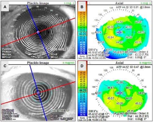 Figure 5 Representative topographical changes in the control group. similar changes were also observed in corneal topography and axis deviation at baseline (A and B) and 1 month after debridement (C and D).