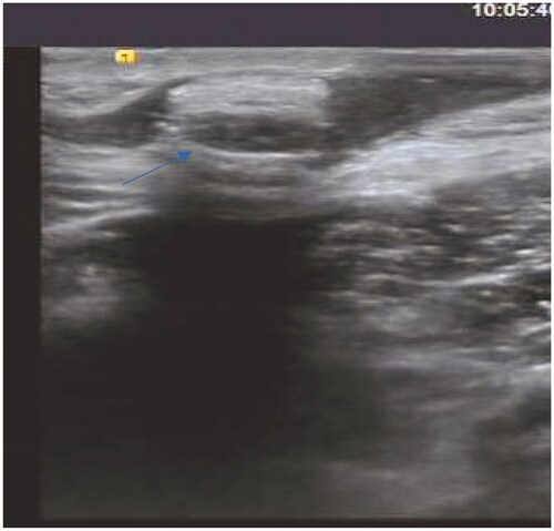 Figure 5. B-Mode Ultrasound Image of case 3.
