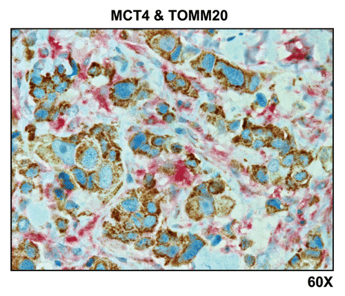 Figure 7 Visualizing the “reverse Warburg effect” by double labeling with MCT4 and TOMM20: Lymph node metastasis. Paraffin-embedded sections of human breast cancer-positive lymph nodes were immunostained with antibodies directed against MCT4 (red color) and TOMM20 (brown color). Slides were then counterstained with hematoxylin (blue color). Note that MCT4 staining is predominantly localized to the cancer-associated lymph node stroma. In contrast, TOMM20 is strongly associated with the metastatic breast cancer cells. Original magnification, 60x.