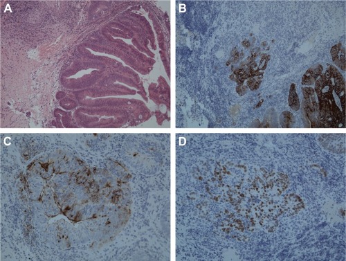 Figure 1 Immunohistochemistry demonstrated on vaginal biopsy.