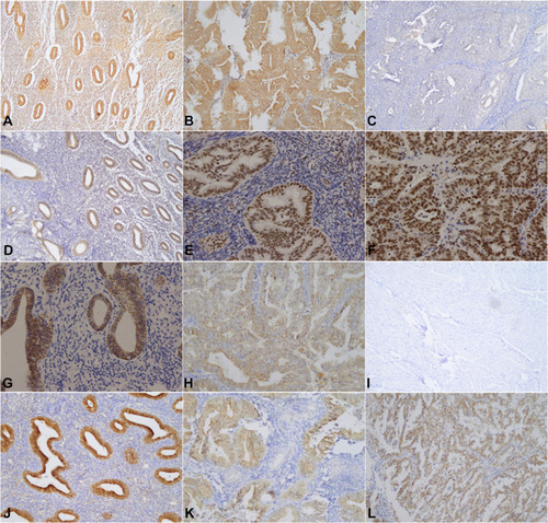 Figure 1 Immunohistochemical staining of normal endometrial tissue, atypical hyperplasia endometrial tissue and endometrial tumor tissue was carried out using thestreptavidin-peroxidase method. Normal endometrial tissue: Figure (A)Wnt5a(+), Figure (D) EZH2(-); Figure (G) E-cadherin(+), Figure (J) β-catenin(-). Atypical hyperplasia of endometrial tissue: Figure(B) Wnt5a(+), Figure (E) EZH2(+), Figure (H) E-cadherin (+), Figure (K) β-catenin(+). Endometrial carcinoma tissue: Figure (C) Wnt5a(-), Figure (F) EZH2(+), Figure (I) E-cadherin (-), and Figure (L) β-catenin(+).