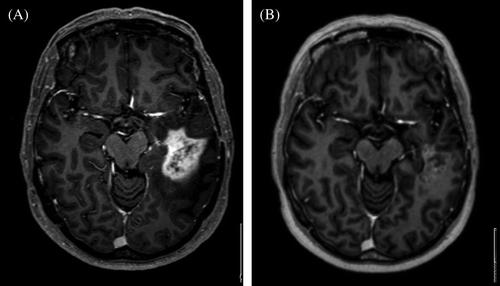 Figure 1.  (T1 weighted gadolinium enhanced MRI scans ). A 54 year old female patient diagnosed with glioblastoma September 2006. She was primary treated with postsurgical radiotherapy- temozolomide and adjuvant temozolomide. One year later the disease progressed. Re-operation was not possible and chemotherapy with PCV schedule was started. Due to further progress valganciklovir was initited. In january 2008 after confirmed progressive disease (Figure 1A) treatment was initiated with bevacizumab and irinotecan according to the schedule described in the paper. Four months later she was in a good condition without any corticosteroids, working as a hairdresser (Figure 1B).
