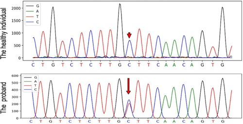 Figure 2. DNA sequence of the L-ferritin gene encompassing the c.-167C > T mutation in the proband and in a healthy individual. The mutation is indicated by red arrow.