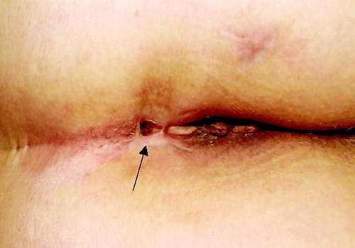 Figure 2.  A photograph of recto-cutaneous fistula (black arrow) of patient 3.