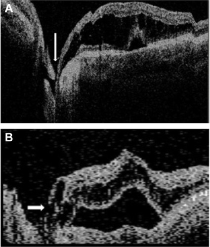 Figure 1 Optical coherence tomography showing the communication between the vitreous cavity and the retina (arrow) in two different cases.