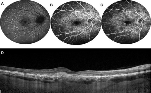 Figure 6 Choroidal neovascularization in STGD1. Fundus autofluorescence (A) shows hyperautofluorescent flecks s and irregular macular hypoautofluorescence. Early (B) and late (C) fluorescein angiography frames demonstrate a parafoveal focal dye leakage, corresponding to a type 1 choroidal neovascularization (CNV). OCT scan (D) reveals growth of the CNV above the RPE with mild exudation, along with focal irregularity/atrophy of RPE/ellipsoid zone layers.