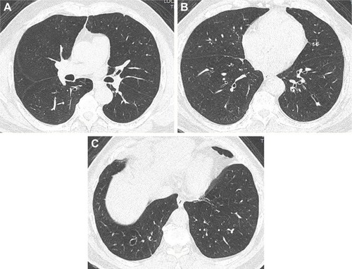 Figure 2 Axial CT images with a lung-window setting showing tubular bronchiectasis with the signet ring sign in the right lower lobe (A–C) and the tram-track sign in the left lower lobe (B).Abbreviation: CT, computed tomography.