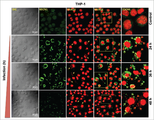 Figure 8. BECN1 expression pattern in macrophages infected with Leishmania. Confocal photomicrographs showing BECN1 expression and infected parasites in THP-1 cells infected with L. donovani. THP-1 cells were infected with promastigotes of Leishmania and were allowed to proliferate for 24, 36 and 48 h postinfection. Uninfected cells were used as controls to compare the level of BECN1 across different times. Cells were subsequently fixed and immunostaining was carried out using anti-BECN1 antibody (green). A fluorescent nucleic acid probe, DRAQ5 (red), was used to stain cell nuclei of macrophages and parasites. Scale bars: 10 μm for 63x images. Confocal microscopy was performed to acquire images. Experiments were repeated 3 times; the images shown are representatives of a single experiment.