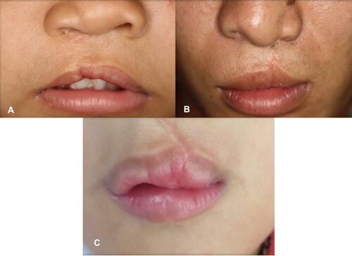 Figure 4 These images illustrate red lip deformities. (A) Convex and Deviation of lip contour, (B) Deviation of lip contour, (C) Unilateral thickening of lip.