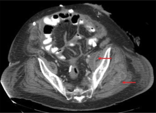 Figure 2 Repeat CT-scan showing abscesses in the left gluteal muscles, indicated by red arrows.