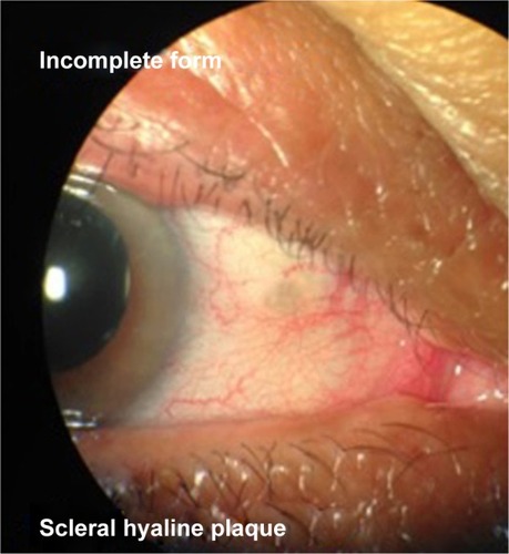 Figure 2 Biomicroscopy of anterior segment – scleral hyaline plaque – Incomplete form.