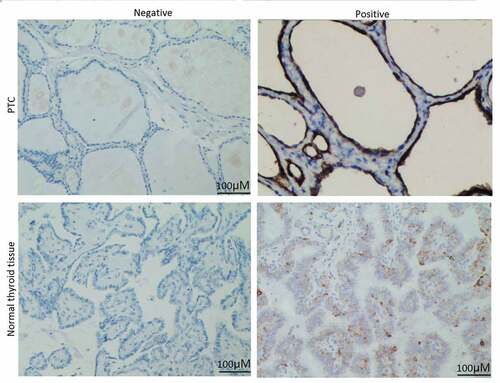 Figure 1. eIF5A2 is upregulated in human PTC samples. Representative images of eIF5A2 immunohistochemical staining in PTC and in normal thyroid tissue