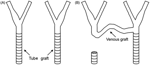 Figure 1. Clinical case: (A) the left and right CA before surgical intervention and (B) post-operative anatomy – carotid–carotid cross-over bypass.