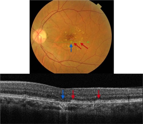 Figure 13 The B-scan line on the fundus photograph (top) has the same width as the B-scan SD-OCT image (bottom) demonstrating one area of geographic atrophy (blue arrow) surrounded by multiple subretinal drusenoid deposits (red arrows).