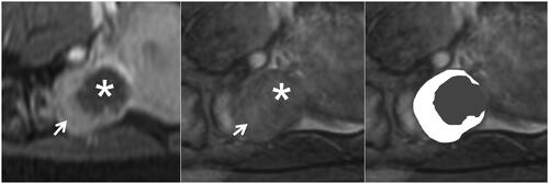 Figure 2. The similar relative signal intensity of leiomyomas on SWI after MRgFUS treatment. The left, Middle, and right figures show the CE, SWI imaging, and SWI sketch of the same leiomyoma. (Left) The axial CE imaging shows that the ablated necrotic lesion is observed as non-enhancing hypointense zones (star), and surrounding residual leiomyoma appeared to be an enhancing hyperintense zone (arrow). (Middle) The corresponding axial SWI shows that the ablated necrotic lesion (star) signal intensity is similar to residual leiomyoma (arrow). (Right) The sketch map illustrates the extent of the ablated lesion (black area) and residual leiomyoma (white area).