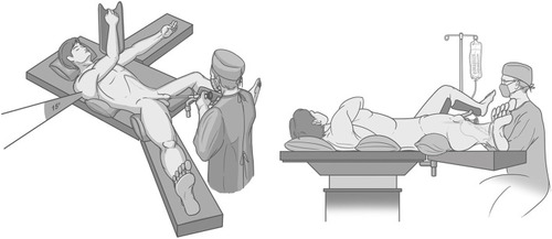 Figure 3 The patient was placed in modified-lithotomy position. The left leg was in lithotomy position, while the right leg was abducted as laterally as possible.