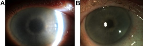 Figure 4 Before and after photographs of right cornea.