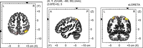 Figure 4 Voxel-wise statistical non-parametric map (SnPM) of sLORETA images in all patients (n=19) during imagery of an general anxiety scenario minus resting state acitivity compared to a general anxiety scenario minus the resting state acitivity in controls (n=15) at the 0.05 significance level after correction for multiple comparisons. Yellow/red shades indicate increased alfa-1 sources (red for P<0.1; yellow for P<0.05). Structural anatomy is shown in gray scale (A – anterior; P – posterior; L – left; R – right).