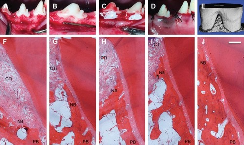 Figure 5 Sequence of in vivo procedures.Notes: (A) Mucoperiosteal flaps were elevated to expose periodontal buccal bone walls. (B) The defects were having the following dimensions: 5 mm apicocoronally, 5 mm mesiodistally, and 3 mm buccolingually. (C) After scaling periodontal ligament scales and debris from defects, an impression material (Impregum Soft™, 3M) was completely filled in the defects. (D) The defects were covered by biomaterials and the mucoperiosteal flaps were restored. (E) ROI was used in analysis of alveolar bone. (F–J) Histology of bone regeneration in class II furcation defects at 8 weeks. (F) The control group. (G) The S0 group with BMP-2. (H) The S1 group with BMP-2. (I) The S2 group with BMP-2. (J) The S3 group with BMP-2. Scale bar =500 µm.Abbreviations: CTi, connective tissue; NB, new bone; PB, pre-existing bone; ROI, region of interest; S, solution.