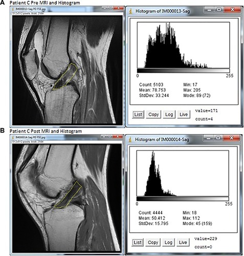 Figure 4 MRIs and histograms for Patient C, (A) pre- and (B) posttreatment.