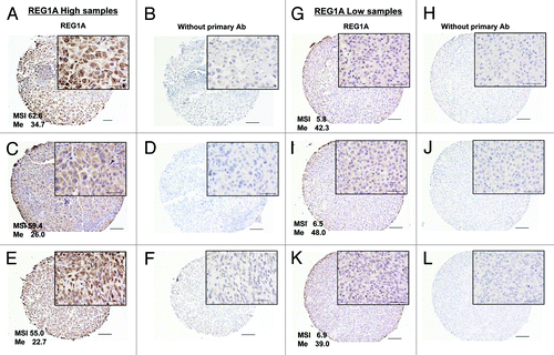 Figure 4. REG1A expression analysis by IHC LN TMA. Whole TMA core views are 100x and partial views are 400x. Bar represents 100 μm in 100x and 20um in 400x. (A, C, and E); Strong REG1A expression tumors and respective MSI values showing low Me (%). (B, D, and F) Controls without primary Ab staining of (A, C, and E), respectively. (G, I, and K) Weak REG1A expression tumors and respective MSI values showing high Me (%). (H, J, and L) Controls without primary Ab IHC staining from the tumors of (G, I, and K), respectively. Me (%): CpG #6 methylation status.
