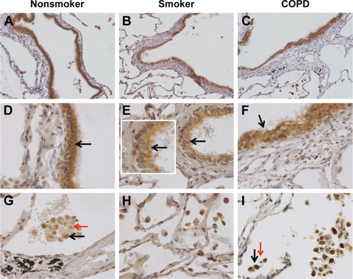 Figure 1 nSMase-2 labeling in human lung tissue.Notes: Representative images for nSMase-2 expression (brown) within the peripheral lung tissue from (A, D, G) NS, (B, E, H) S, and (C, F, I) COPD patients. nSMase-2 was detected within the small airway epithelium (A–F) with a more pronounced expression toward the apical surface (inset arrow). nSMase-2 was also detected within the alveolar macrophages and alveolar walls (G–I). nSMase-2-positive alveolar macrophages (black arrows) observed near alveolar macrophages lacking nSMase-2 expression (red arrows). Magnification ×200 (A–C) ×600 (D–I).Abbreviations: NS, nonsmoker; S, smoker.