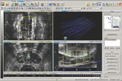 Figure 1 Prostate (yellow contour), uretheral (green contour), catheters (white dots in the axial image), and their reconstructions (blue circles and catheters) shown in a TRUS image-based prostate high dose rate planning system. The coronal, axial, and sagittal views of the TRUS image are shown in the left upper, left lower, and right lower panes, respectively.Abbreviation: TRUS, transrectal ultrasound.