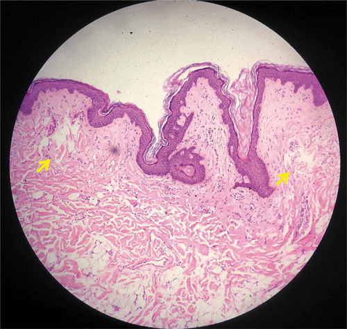 Figure 6. Histology from specimen No.6 demonstrating intra-dermal LIC (Hematoxylin and eosin (H&E), 100X).