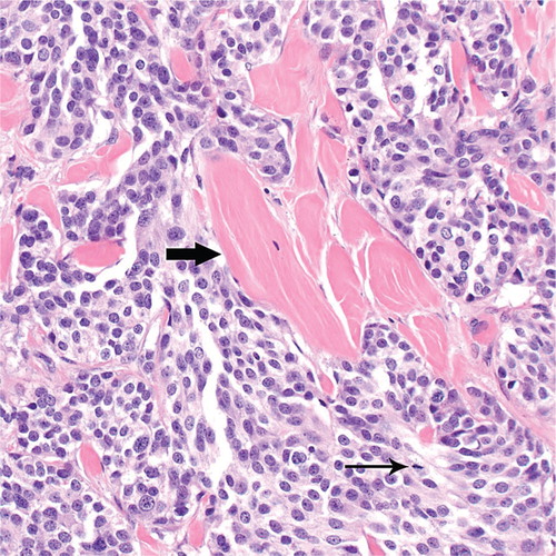Figure 2. Medullary thyroid carcinoma metastatic to the skin and subcutaneous soft tissues of the chest (March 2009). Notice the bands of amyloid (thick arrow) interspersed between nests of tumor cells. An occasional mitotic figure is seen (thin arrow). Hematoxylin and eosin, original magnification ×400.