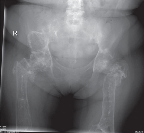 Figure 1 Pelvis, hips, and upper femora of adult Gaucher patient.