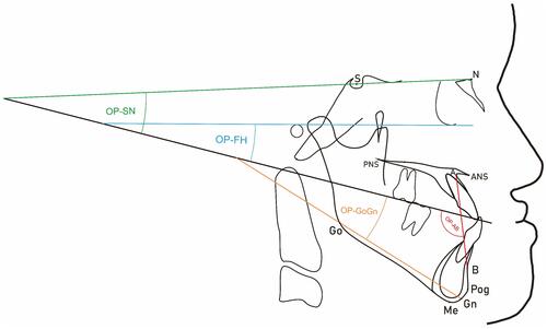 Figure 3 Anatomical lines and angles used in this study to determine the inclination of the occlusal plane.