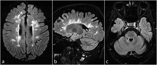 Figure 1. Axial and sagittal fluid-attenuated inversion recovery (FLAIR) MRI sequences of the brain, showing several new periventricular, Juxtacortical (a and b), brainstem, and cerebellar peduncle (c) lesions