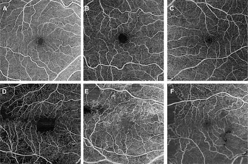 Figure 2 A-F show 6 x 6 mm original macular SS-OCTA en face images from the total retinal layer slab of patients with varying stages of diabetes and retinopathy from a (A) healthy control with no diabetes (B) a patient with diabetes and no retinopathy, (C) mild non-proliferative DR, (D) moderate non-proliferative DR, (E) severe non-proliferative DR and (F) proliferative DR. As the DR becomes more severe, increased vasculature loss can be seen as areas of darker patches with no microvasculature evident.