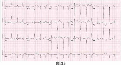 EKG b Initial EKG on presentation showing AVNRT with possibly WPW syndrome