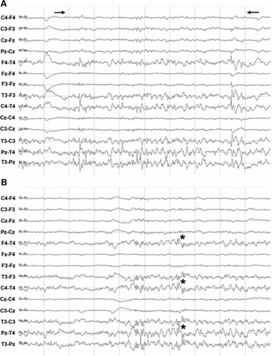 Figure 4. EEG recording during drowsiness or sleep in a horse. (a) Theta waves (indicated between → and ←) seen during a period of drowsiness: irregular waves of 5–6 Hz and amplitude 10–40 μV. The waves occurred for a period of approximately 7 seconds. Scale: amplitude 50 μV/division and 1 second/division. (b) Sleep spindles indicated by * are seen as single waves of 10–12 Hz with an amplitude of 30–60 μV. Scale: amplitude 50 μV/division and 1 second/division.