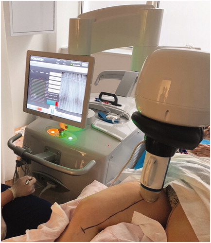 Figure 1. Sonovein (HIFU) machine being used to treat the right Great Saphenous Vein in a clinic room.