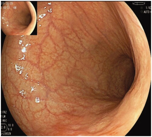 Figure 3. Severe atrophic gastritis, diminished rugal fold and submucosal grid vessel in the corpus.