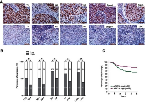 Figure 2 Low ARID1A expression was associated with advanced TNM stage and poor prognosis in NPC patients. (A) Representative images of ARID1A expression in NPC biopsies with different TNM stages. High expression of ARID1A was observed for the T1, N0, M0, and I stage and DNKC subtype NPC biopsies, while low expression of ARID1A was detected for the T4, N3, M1, and IV stage and UDC subtype tumors. (B) Numbers and percentages of cases with high or low expression of ARID1A according to different clinicopathological features. (C) Low ARID1A expression was associated with a poor prognosis in NPC patients. *P<0.05, **P<0.01, #P<0.001.Abbreviations: NPC, nasopharyngeal carcinoma; ARID1A, AT-rich interacting domain-containing protein 1A; DNKC, differentiated nonkeratinized squamous carcinoma; UDC, undifferentiated nonkeratinized carcinoma.