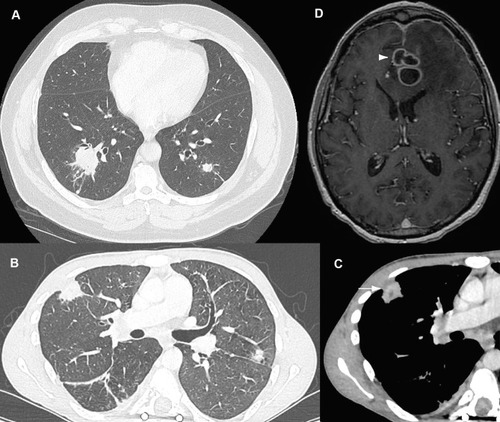 Figure 2 Radiographic findings in patients with invasive nocardiosis. (A) Chest CT-scan of a sixty-year-old patient with chronic lymphocytic leukemia treated with ibrutinib who developed Nocardia pneumonia. (B and C) Twenty-one-year-old patient with chronic granulomatous disease who developed Nocardia pulmonary abscess with local extension to the ribs (white arrow). (D) Brain MRI of a forty-six-year-old cardiac transplant patient who developed Nocardia brain cerebral abscess (white arrowhead): ring-enhancing multilobulated lesion surrounded by edema causing a mass effect on the anterior ventricles. MRI, axial T1 after gadolinium injection.